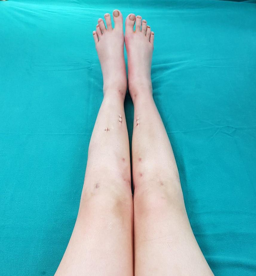 Differences between leg lengthening at the tibia and femur