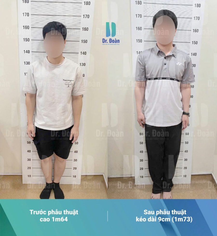 Từ Nhật Bản Về Việt Nam – Hành Trình Chạm Tới Chiều Cao Mơ Ước