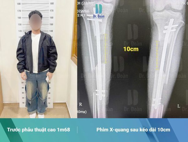 Từ 1m68 đến 1m78: Bước Tiến Của Chàng Trai Trên Hành Trình Bước Ra Thế Giới