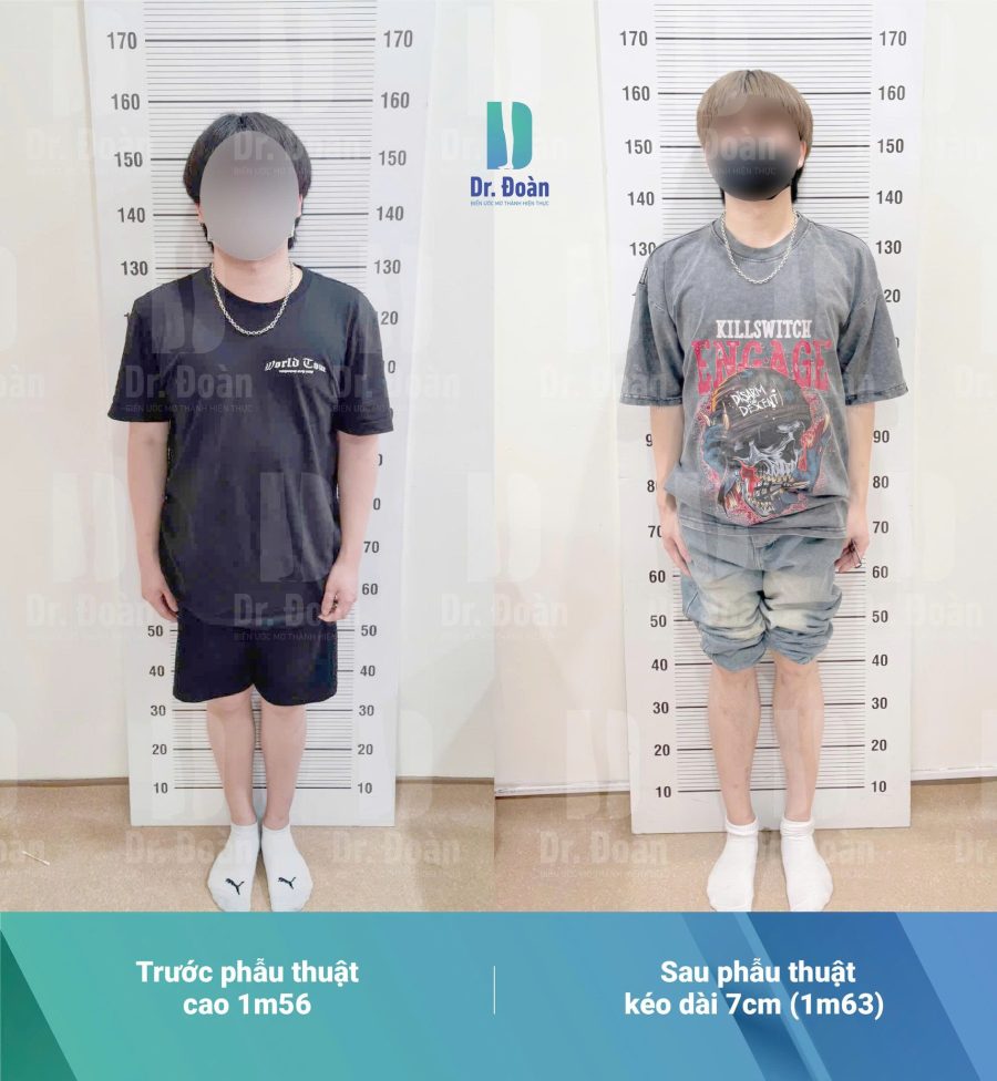 Kỹ sư Việt tại Mỹ: Tăng 7cm để nâng tầm ngoại hình và sự nghiệp