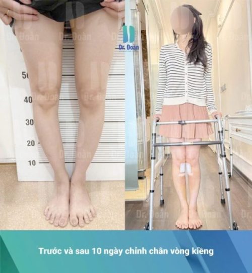 Chỉnh chân vòng kiềng – Khi vóc dáng không chỉ đến từ chiều cao