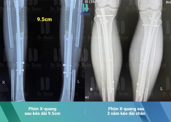 Tăng 9,5cm – Bước ngoặt lớn cho nhân viên kinh doanh trẻ