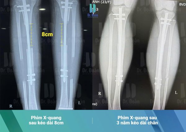 Tháo đinh nội tủy sau kéo dài chân: Khi nào là thời điểm thích hợp?