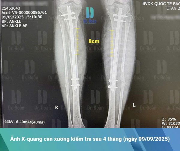 4 tháng sau kéo dài chân – Kết quả ấn tượng ngoài mong đợi