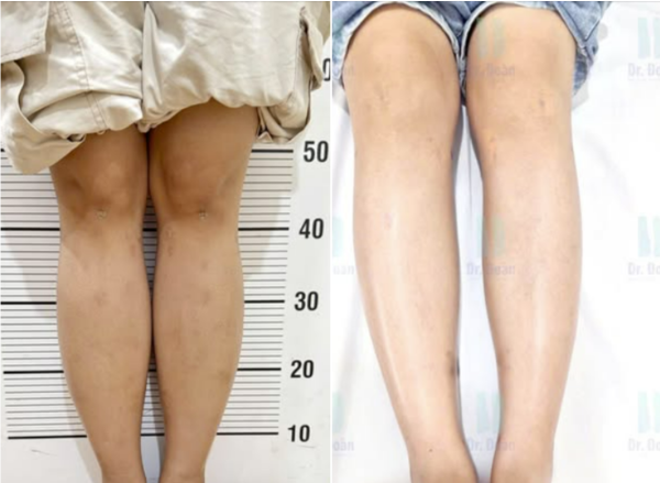 Sẹo sau khi tháo khung: nhỏ, mờ dần và không đáng lo ngại